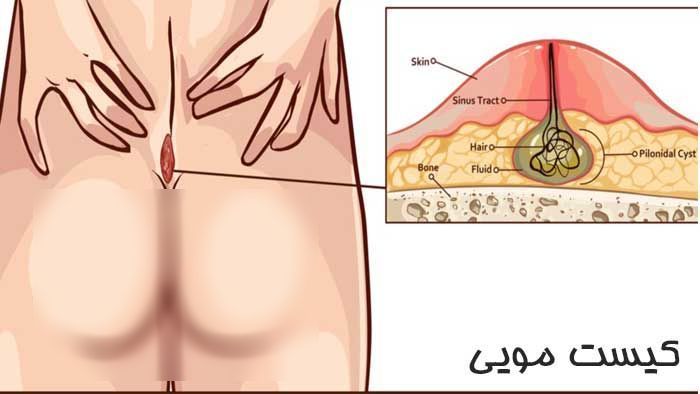 بهترين درمان كيست مو چيست؟