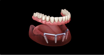 استرس |امنیت |ایمپلنت دندان مصنوعی متحرک