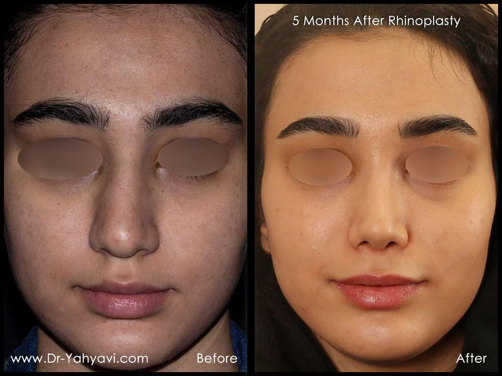 جراحی |عمل بینی جراحی |عمل بینی