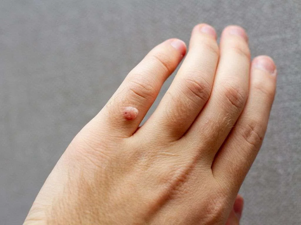 زگیل |زگیل تناسلی