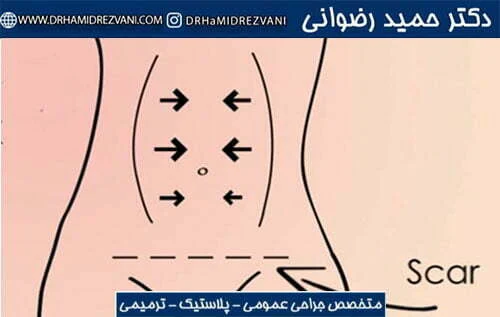 Tightening-of-surgical-sutures