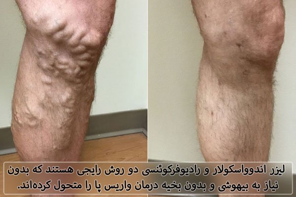 عکس قبل و بعد از درمان واریس طنابی