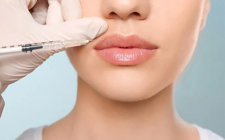 همه چیز درباره فیلر لب روسی [عوارض + مراقبت پس از تزریق]