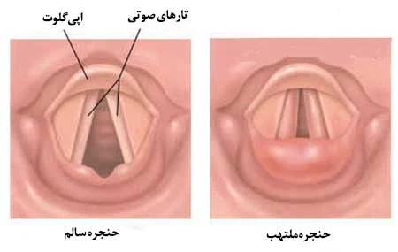 عکس حنجره