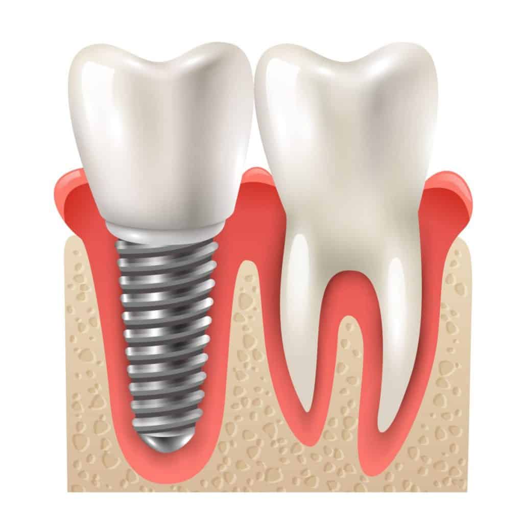 چرا جای خالی دندان را نباید نادیده گرفت؟ اهمیت درمان ایمپلنت برای سلامت دهان و کیفیت زندگی
