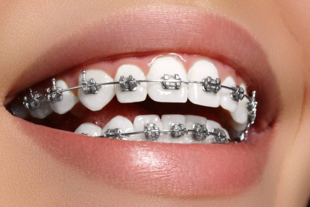 آیا ارتودنسی برای شما انتخاب درستی است؟ 6 معیار برای تصمیم‌گیری قبل از شروع درمان